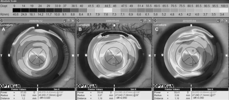 FIGURE 1. A, Corneal topography of an eye before pregnancy (patient 1, right eye). B, Progression in keratometric values and size of the cone were noted about 11 months later, at the sixth month of pregnancy in the same eye