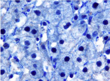 Fig. 1. Estrogen receptor expression in patients with nonalcoholic steatohepatitis.