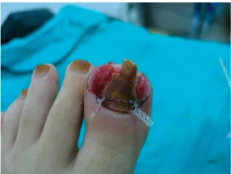 Figure 1. A case with bilateral granulation tissue that is not adjacent to the nail matrix.