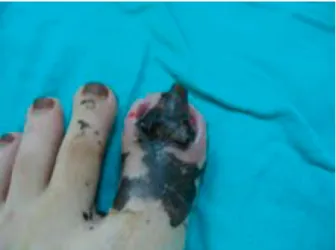 Figure 2. The same nail in 10 days with potassium per- per-manganate foot bath, nail brace, and silver nitrate application.