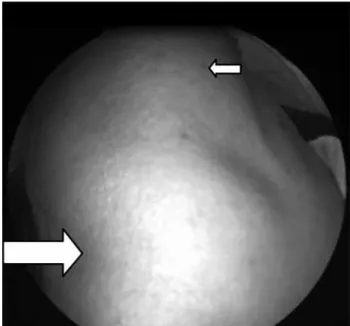 Figure 1. The pulsatile mass was located at the posterior wall  of oropharynx (showed by small arrow) at the right