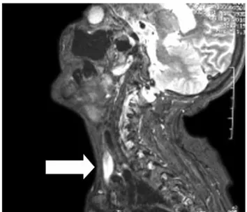 Figure 5.  Left internal carotis artery. Figure 6.  Postoperative magnetic resonance angiography image which shows anastomosis.