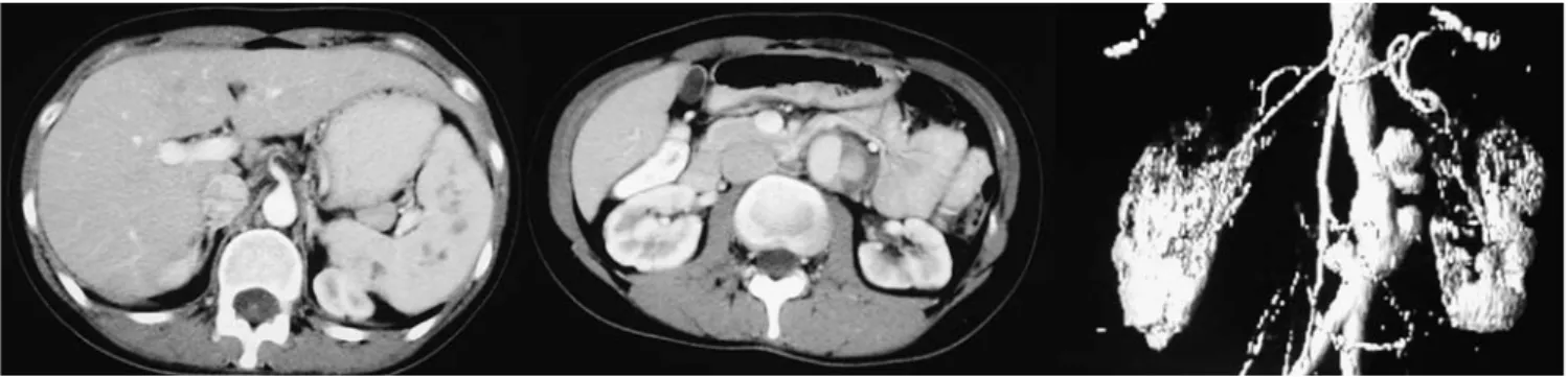 Fig. 1 a Abdominal CT; multiple irregular hypodense lesions in the spleen with a maximum size of 2 cm