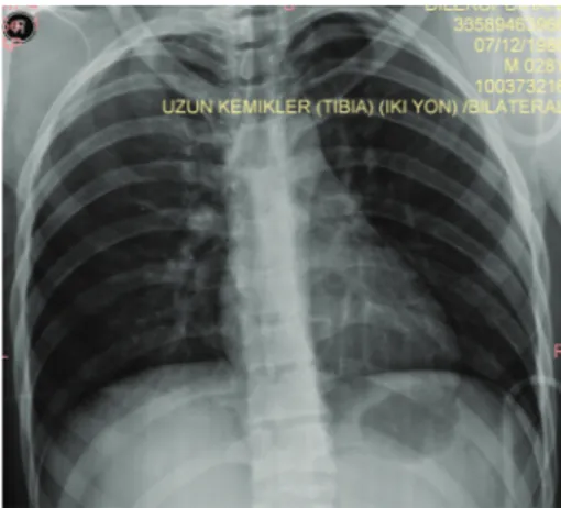 Figure 3: Chest X-ray of the patient.