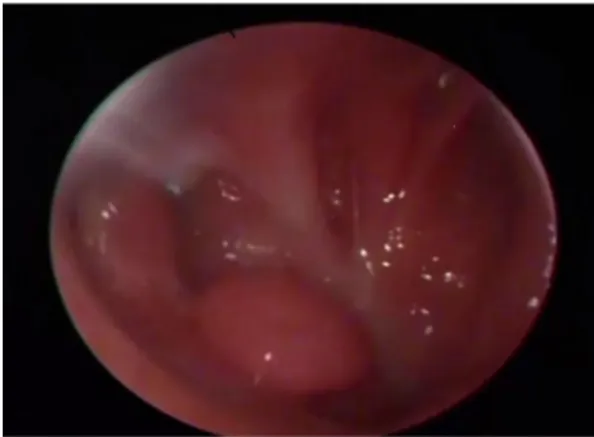 Fig. 1 Preoperative endoscopic view of the lesion