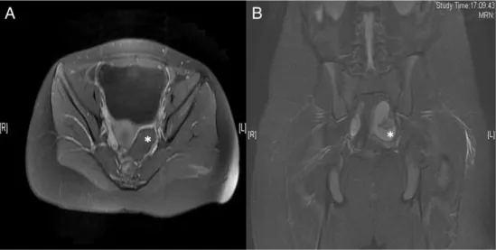 Fig. 1 A: Post-contrast T1 weighted axial picture crossing through the bladder reveals the enhancing soft tissue besides the enlarged left ovarian tube (*) indicating decreased perfusion of the tubal wall