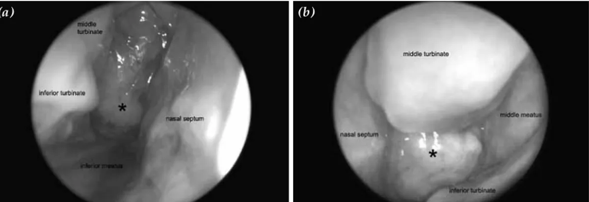 Figure 1.  Right and left nasal cavities with a viewes of the zero degree endoscope. (a) Right middle and lower  nasal meatus filled by mass