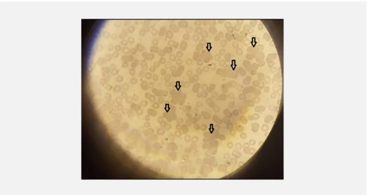 Figure 2: Grape shaped agglutination of erythrocyte in peripheral blood smear (x1000)