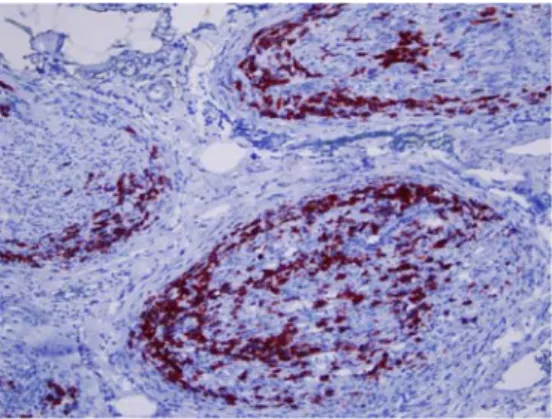 Fig. 4 The tumor was composed of cells express CD20 immunopo- immunopo-sitivity. Avidin-biotin immunoperoxidase stainingX400