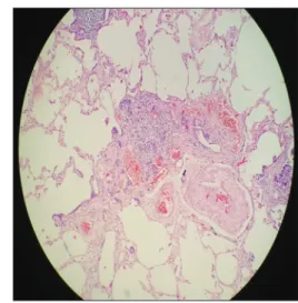 Figure 4: Bilateral diffuse millimetric nodules and subpleural reticular infiltration in  bilateral bases in high‑resolution computed tomography