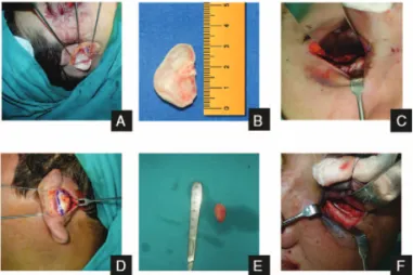 FIGURE 1. (A) Intraoperative view removal of the conchal cartilage graft. (B) Intraoperative view of the conchal cartilage graft