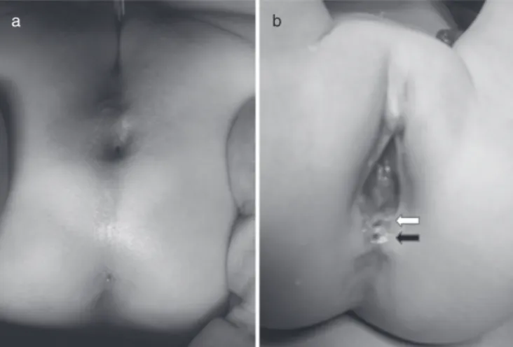 Fig. 1 Preoperative images. (a) Patient 1: orifice of the rectal dupli- dupli-cation cyst at the anal dimple; (b) patient 2: two orifices at the vestibulum (white arrow, rectovestibular fistula; black arrow, orifice of rectal duplication cyst).