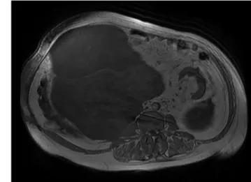 Figure 2. Magnetic resonance imaging view of renal leiomyosarcoma-2 Figure 4. Operative view of the lesion