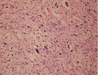 Figure 6. Microscopic view of the retroperitoneal mass  excision material in 2012