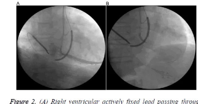 Figure 2. (A) Right ventricular actively fixed lead passing through tricuspid valve. Also  venography of posterolateral branch of coronary sinus with selective intubation of inner  catheter; (B) A coronary guide wire coursing distally for delivery of left 