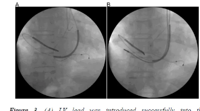 Figure 3. (A) LV lead was introduced successfully into the posterolateral branch over the  guide wire; (B) Final positions of the right atrial, right ventricular and coronary sinus leads