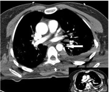 Figure 1.  Thorax  computed  tomography  shows  indentation  of  descending  aorta  by  edge  of  broken  left  sixth  rib  (arrows)  and  hemothorax.