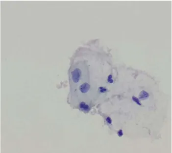 Fig. 2. Binucleation is seen in this LBS. Case was interpreted as low grade squamous intraepithelial lesion