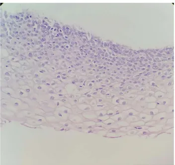 Fig. 5. High-power magnification of cervical biopsy. Epithelial cells with pleomorphic nuclei and nuclear enlargement are mainly at lower levels