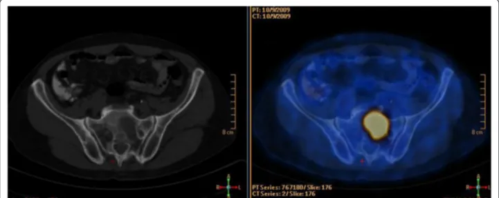 Figure 1 Transaxial CT and fused PET/CT images of a 65-year-old male patient with rectal cancer