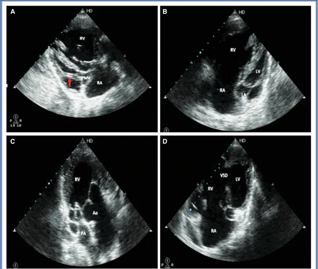 Figure 1.   (A) Concordance atrioventricular connection, supramitral membrane, insertion of all the mitral  valve’s chordae tendineae into a single papillary muscle (arrow) (B) rudimentary left ventricle, (C) double  outlet  right ventricle, mild pulmonary