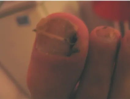 Figure 1. A patient with nail appara- appara-tus, granulation tissue almost  disap-peared.