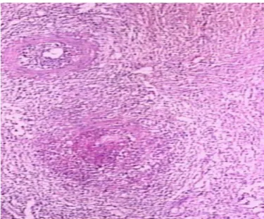 Fig. 1. Transmural inﬂammation and ﬁbrinoid necrosis of medium-sized or small arteries