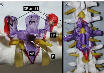 Fig. 3  Pedicle subtraction osteotomy. a) An L3 pedicle  subtraction osteotomy plan from the lateral view