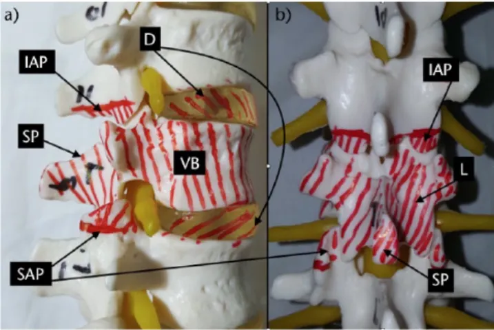 Fig. 7  Vertebral column resection. a) Lateral view. Lower facets  of the upper and upper facets of the lower vertebrae should be  removed to allow removal of the laminae and pedicles of the  vertebra to be resected