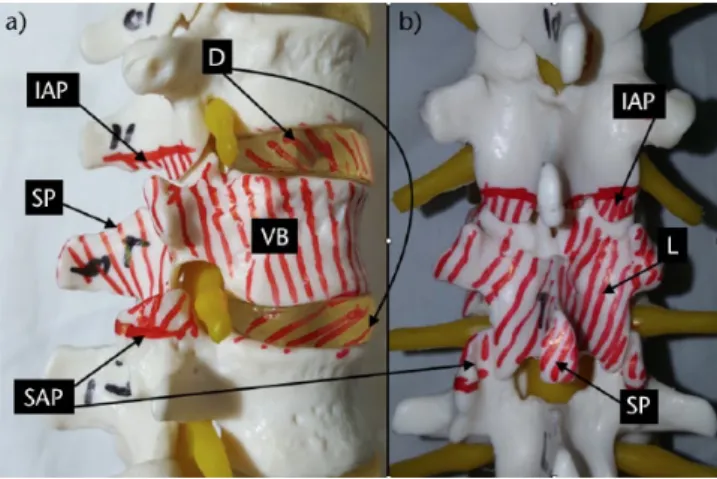Fig. 7  Vertebral column resection. a) Lateral view. Lower facets  of the upper and upper facets of the lower vertebrae should be  removed to allow removal of the laminae and pedicles of the  vertebra to be resected