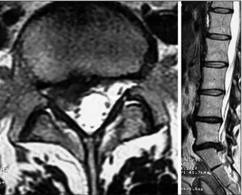 Figure 2: Lumbar disc herniation is seen to be resorbed on follow up axial (left) and sagittal (right) T2 weighted MRI of the lumbar spine at the L5-S1 level (June 2008).