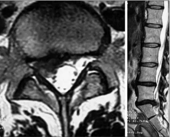 Figure 2: Lumbar disc herniation is seen to be resorbed on follow up axial (left) and sagittal (right) T2 weighted MRI of the lumbar spine at the L5-S1 level (June 2008).