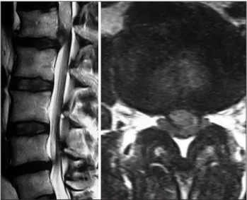 Figure 4: On follow-up T2-weighted MRI of the lumbar spine, the totally regressed extruded disc fragment is seen at the L1-2 level and the dural sac is free from compression (June 2008).