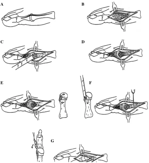 Fig. 1: Illustration of the modified distal chevron procedure and capsuloperiosteal flap stabilization (image originally appeared in The Journal of Foot and Ankle Surgery, 28(1):4, 1999; used with permission).