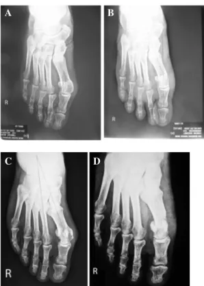 Fig. 2: X-ray examples for hallux valgus. A and B, A 34-year-old female at the time of operation, right hallux valgus with preoperative AOFAS score: 44 pts to postoperative 95 pts at the last followup, preoperative (A) HVA:31 ◦ IMA 1 −2 :11 ◦ ; 11-year pos