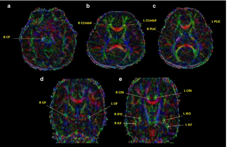 Fig. 1 The regions of interest (ROIs) on coloured fractional anisotropy (FA) maps on axial (A, B, C) and coronal sections (D, E)