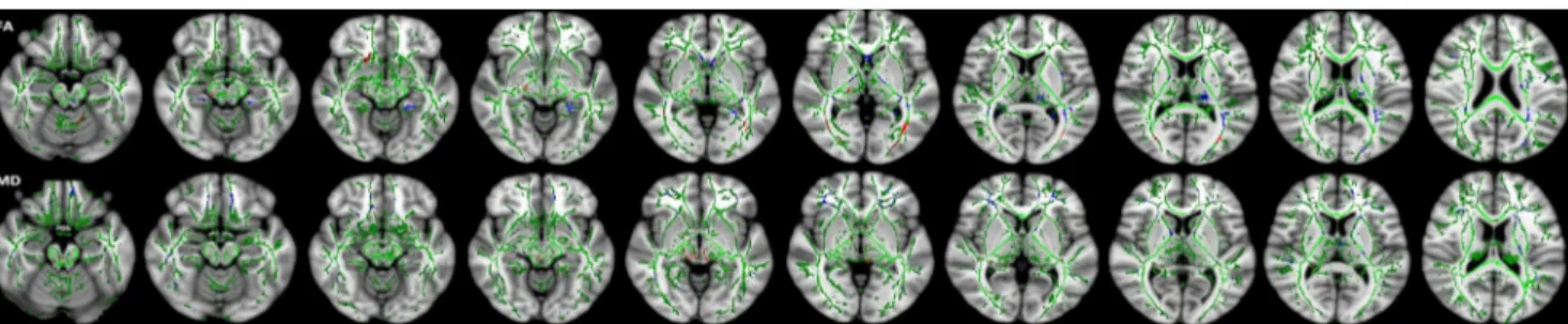 Fig. 3 Fractional anisotropy (FA) values of the most affected white matter (WM) tracts from region of interest (ROI) analyses between children with Down ’s syndrome (DS) and control subjects (p &lt; 0.05)