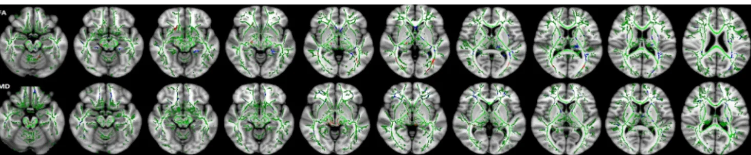 Fig. 3 Fractional anisotropy (FA) values of the most affected white matter (WM) tracts from region of interest (ROI) analyses between children with Down ’s syndrome (DS) and control subjects (p < 0.05)
