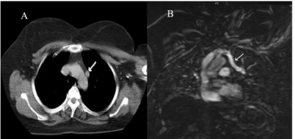 Fig 1. (A) Computed tomography section through upper chest reveals tubular structure showing similar density with aortic arch lumen (white arrow)