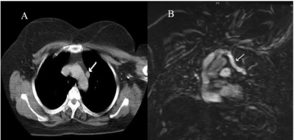Fig 1. (A) Computed tomography section through upper chest reveals tubular structure showing similar density with aortic arch lumen (white arrow)