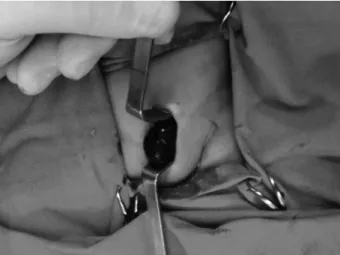 FIGURE 2. The perioperative image of twisted ovary within the hernia sac.