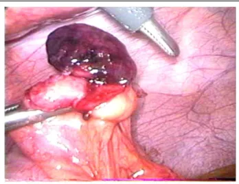 Figure 2 A laparoscopic view of a gangrenous appendix epip- epip-loica on the surface of the sigmoid colon.