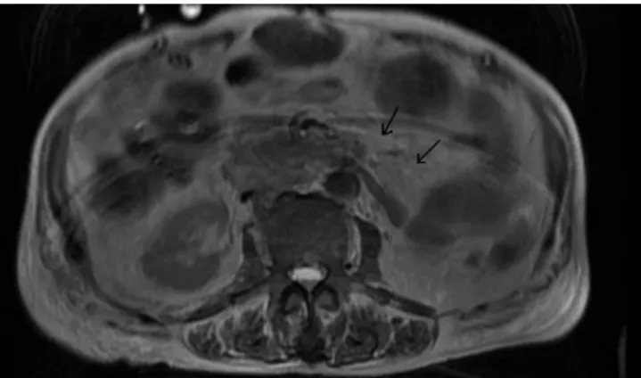 Figure 1. T2 weighted axial MR image shows full transection of the pancreas at  the body with a fluid collection.