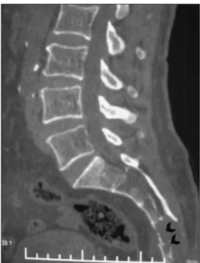 Figure 3: Reconstructive sagittal lumbosacral CT demonstrates  bone destruction in S4 and S5 vertebral bodies (arrow heads).