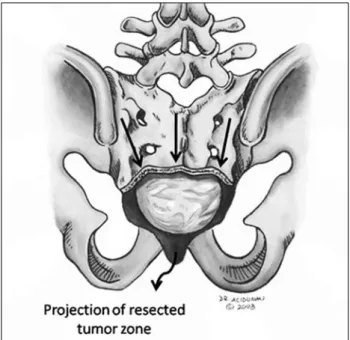 Figure 9: Chordoma having the diagnostic features of lobulation,  myxoid  and  chondroid  matrix  and  vacuolated  cells  with  a  chording arrangement