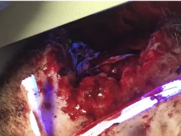 Fig. 2. Massive right cheek soft tissue trauma from a gunshot wound. Fluorescence is seen in the wound bed demonstrating injury to the parotid duct.