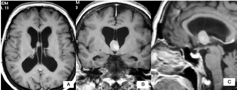 Fig. 1. Magnetic resonance imaging scan of the patient in axial (A), coronal (B), and sagittal (C) planes showing the hyperintense contrast-enhancing mass lesion in the third ventricle with enlarged lateral ventricles and CSP and CV variation.