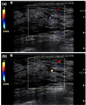 Fig. 2 Effect of color-write priority on intensity of twinkling artifact (Logiq 7, GE Healthcare, linear transducer, 12L, 4.5–13 MHz, Milwaukee, WI, USA)