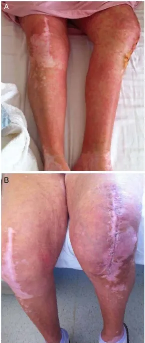 Figure 2 Second patient ’s skin appearance at the initiation of symptoms (A) and after treatment (B).