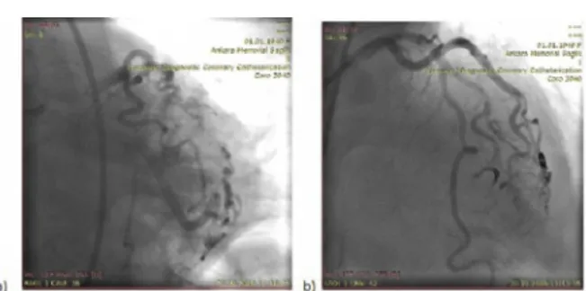Figure 1: Cx and major OM side branch lesions, T and small pro- pro-trusion technique